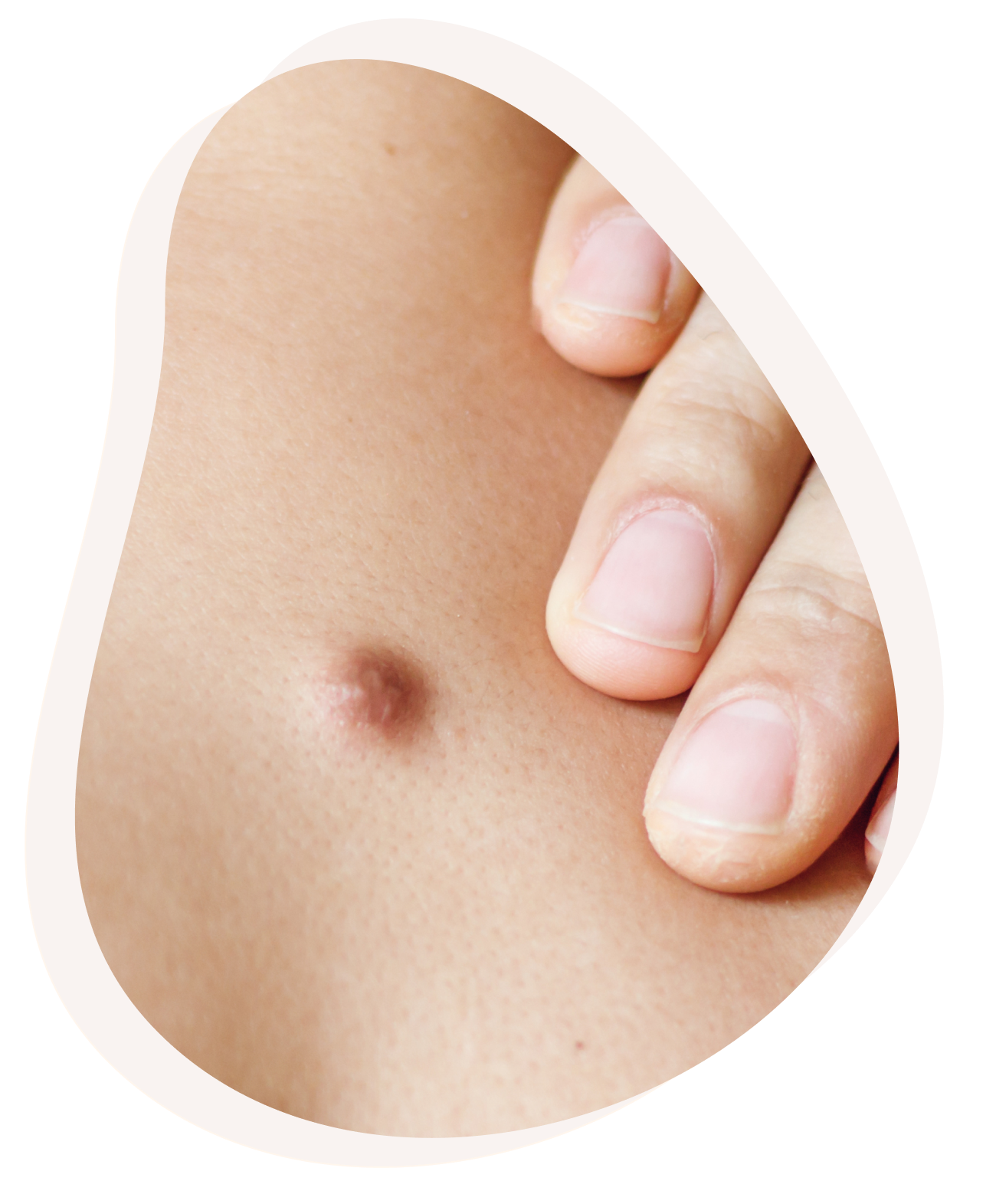 Image d un boton sur la peau d un homme - Chirurgie dermatologique | Centre Villiers Batignolles Paris