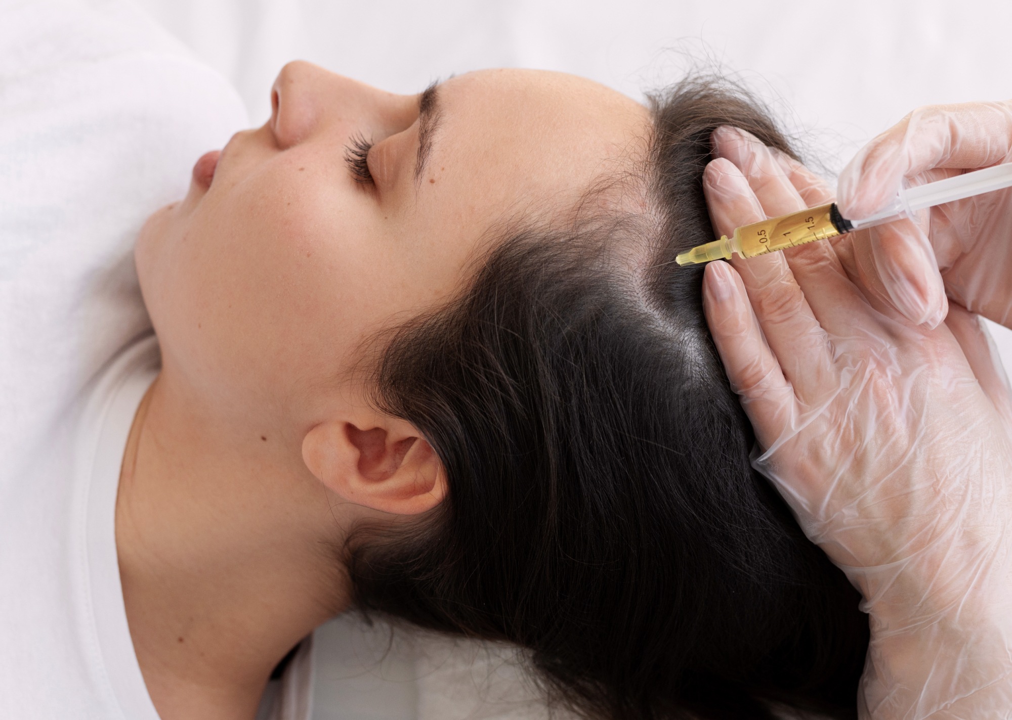 Photo du visage d une femme se faisant une injection dans ses cheveux - mesotherapie cheveux | Centre Villiers Batignolles Paris