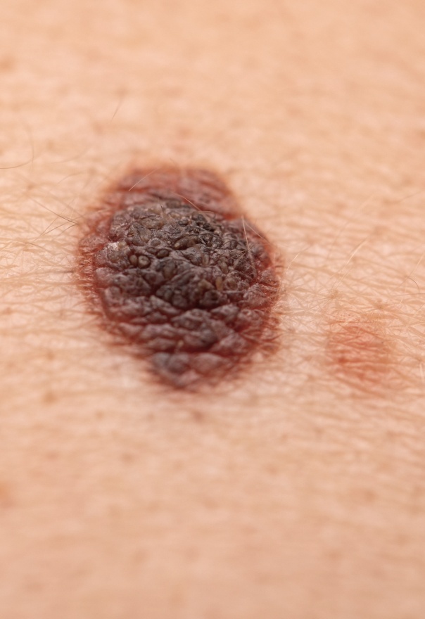 Photo d un grain de beaute marron - grain de beaute chirurgie dermatologique | Centre Villiers Batignolles Paris