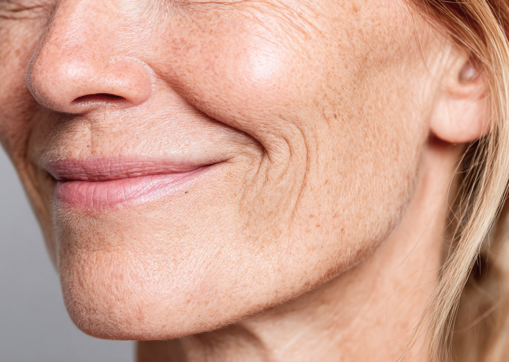 Comblement des rides du sourire et des sillons nasogéniens avec des injections d'acide hyaluronique. Centre Villiers Batignolles, Paris.