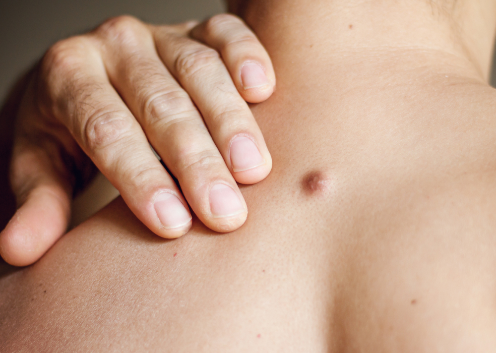 J'ai une bosse sous la peau | Centre Villiers Batignolles